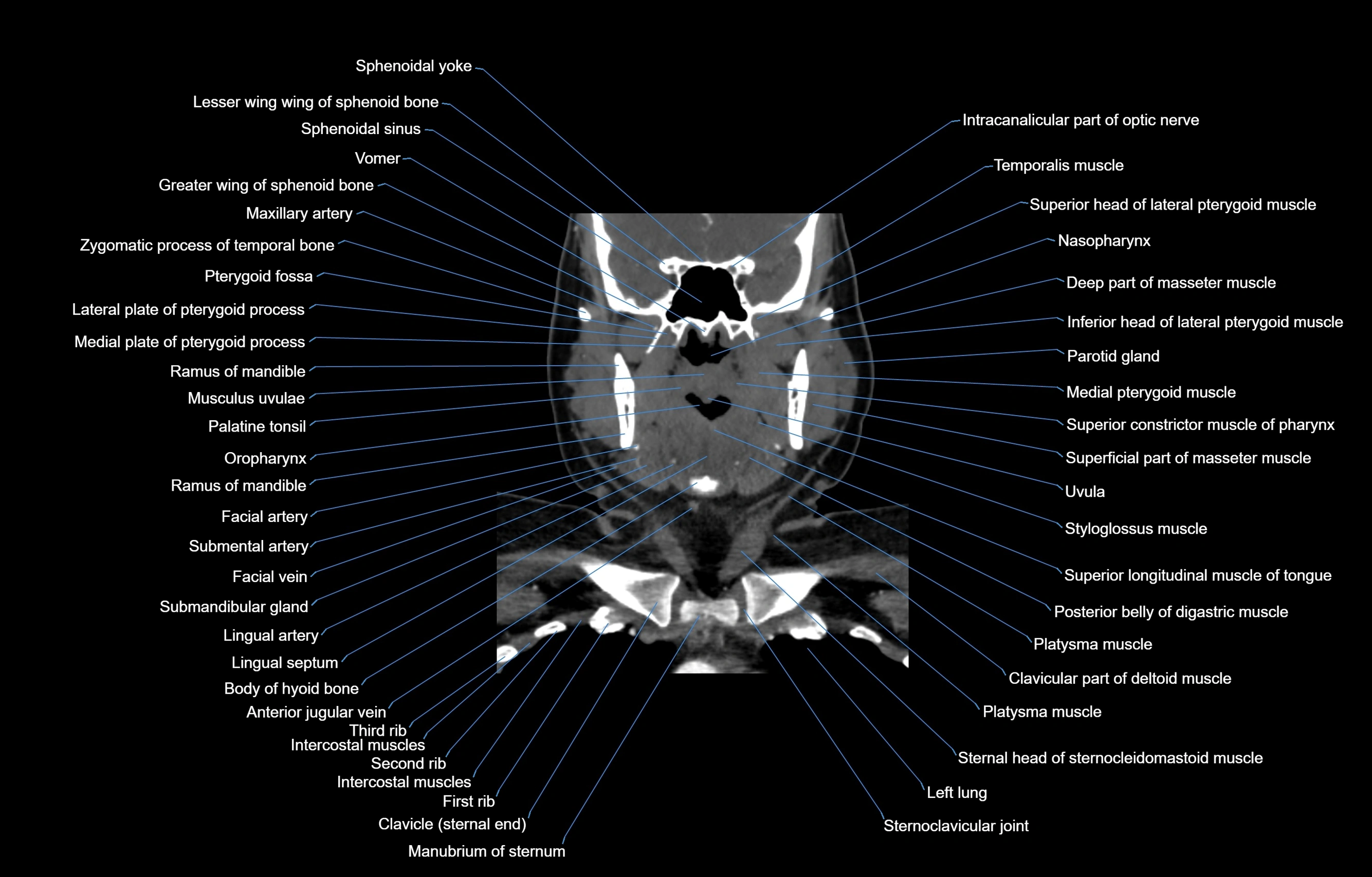 CT Neck coronal  cross sectional anatomy labelled 3D  radiology  image-00027.webp